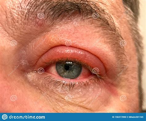 Extreme Close Up On A Man With A Red Inflamed Eye Stock Photo Image