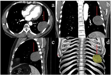 Figure 1 From Schwannoma Of Left Chest Wall A Case Report And