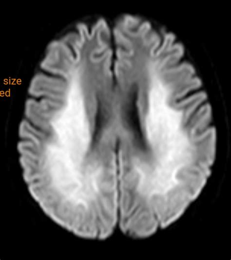 Diffuse Anoxic Brain Injury Post Cardiac Arrest Image