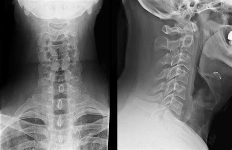 Cervical Spine Radiographs In The Trauma Patient Ep Wellness