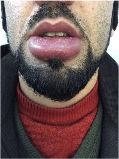 Lupus Erythematosus Chronic Lip Swelling Download Scientific Diagram