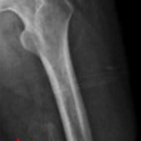 Radiographic Image Demonstrating Heterotopic Ossification Within The