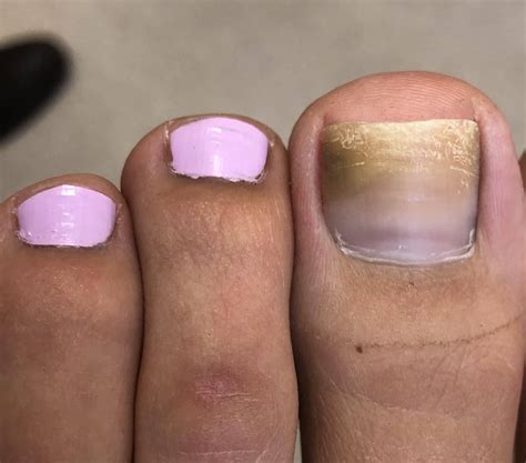 Why Are My Toenails So Ugly Healthy Life Foot Clinic