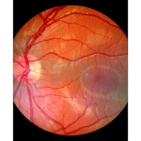Fundus Camera Image Of A Normal Retina Flip Flops By Science Photo