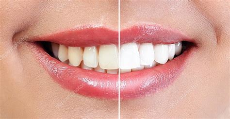 Demonstration Of Dental Whitening Result Before And After Procedure