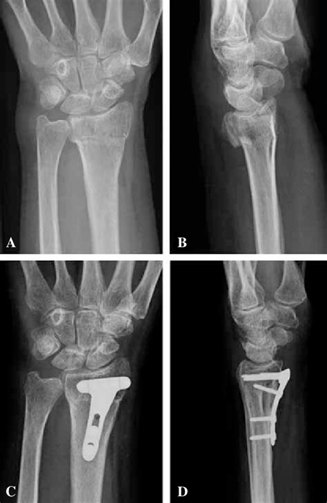 Distal Radius Fracture Treated With A Plate In A 66 Year Old Woman