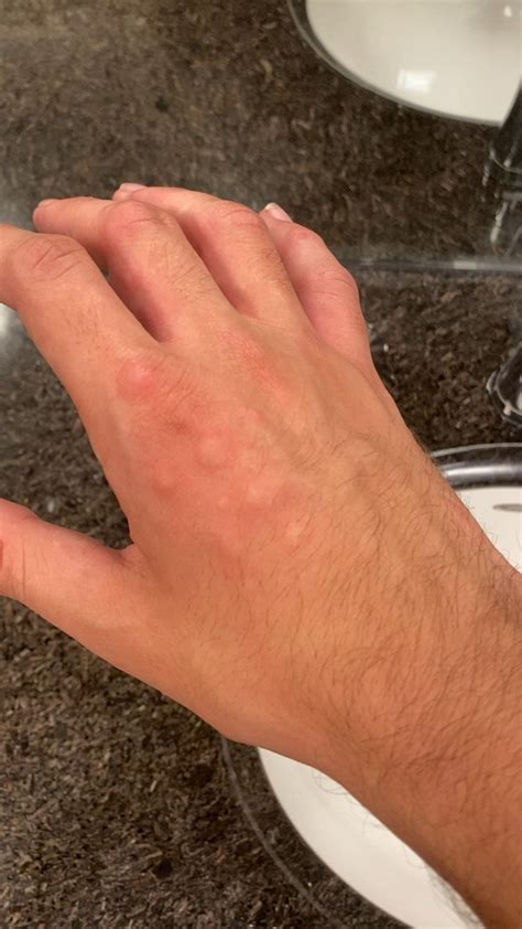 Dermatologists Of Reddit I Need Help Figuring Out These Strange Bumps