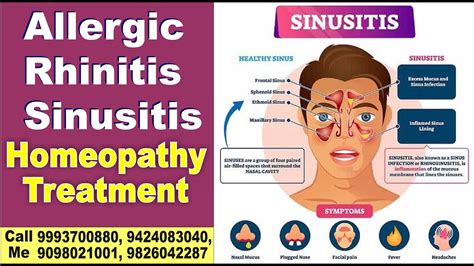 Allergic Rhinitis Sinusitis Homeopathy Treatment Youtube