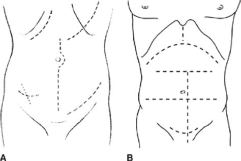 Abdominal Wall Incisions And Repair Including Release Basicmedical Key