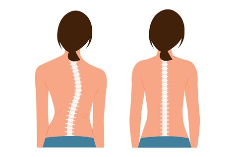 Good Posture And Bad Posture Chiropractic Before After Image