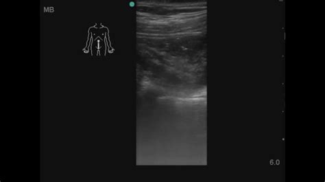 How Accurate Is Point Of Care Ultrasound Pocus At Diagnosing Acute