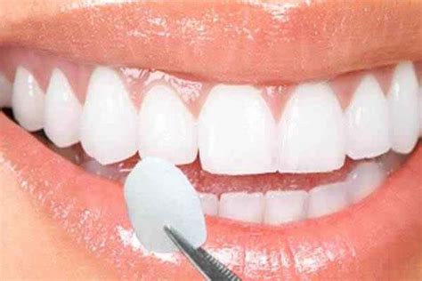 Smile Makeover Digital Smile Design Dubbo Crescent Dental