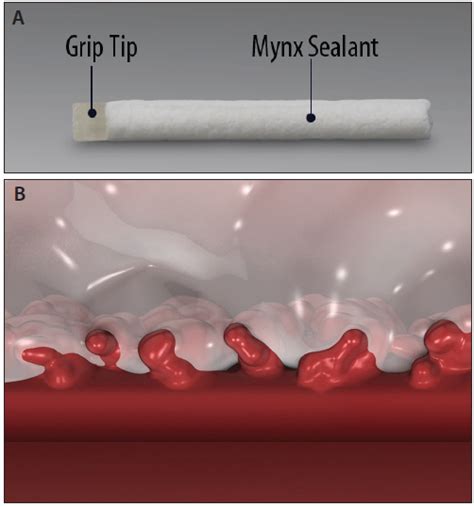 The Mynx Vcd Platform A New Approach To Vascular Closure Cardiac