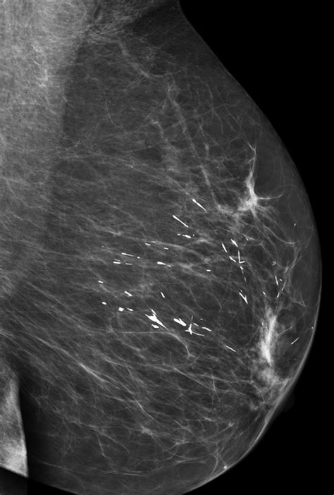 Linear Breast Calcifications Ajr