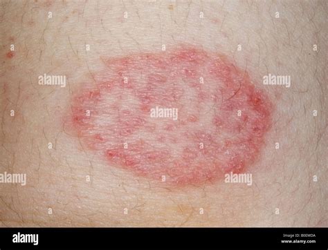 Ringworm Fungus Infection Of The Skin Stock Photo Alamy