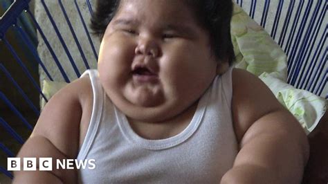 Why Is This Baby So Overweight Bbc News