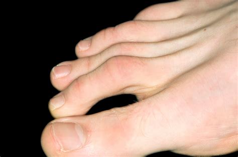 5 Things To Know About Hammertoes Next Step Foot And Ankle Clinic