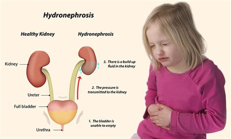 Hydronephrosis In Children Causes Symptoms And Treatment