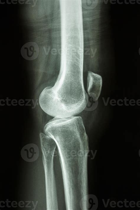 Film X Ray Knee Lateral View Show Normal Human S Knee Joint 2591219