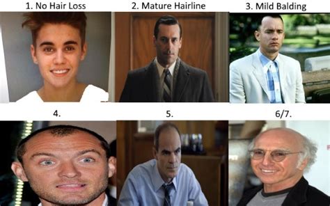 Will You Look Good Bald Five Ways To Know Celebrities Hair Transplants