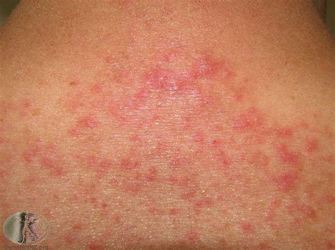 Common Skin Rashes In Adults Itchy