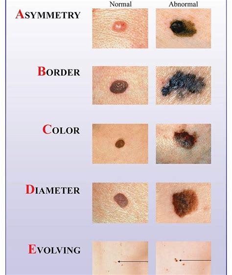 May Is Melanoma Awareness Month American Dermatology Associates