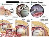 Recovery From Biceps Tenodesis Arthroscopy Surgery Images