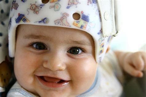 Corrective Baby Helmets Have Virtually No Effect On Head