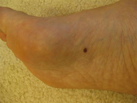 Did You Know You Can Get Malignant Melanoma On Your Feet Sutherland