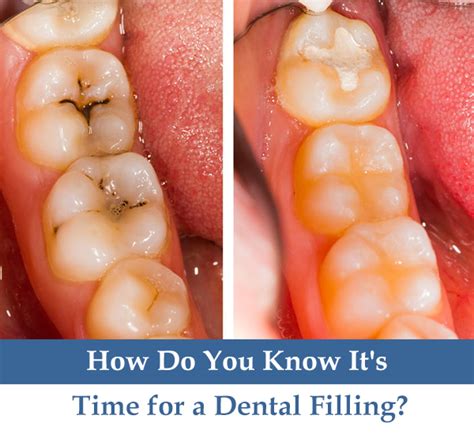 How Do You Know Its Time For A Dental Filling
