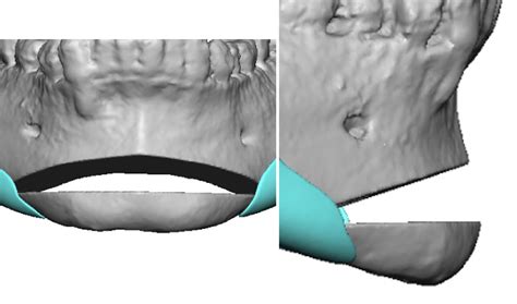 Technical Strategies Interpositional Grafting In Vertical Chin