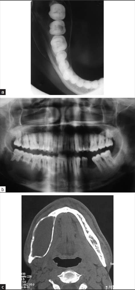 A Mandibular Occlusal Radiograph Showing Expansion Of The Cortical