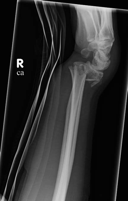 Colles Fracture Radiology At St Vincents University Hospital