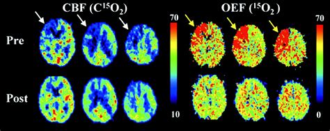 Comparative Overview Of Brain Perfusion Imaging Techniques Stroke