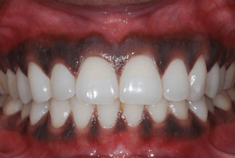 ¿qué Es Un Peeling Gingival Ortoinvisible