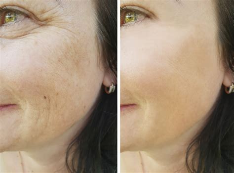 Face Wrinkles Before And After Anti Age Naturally
