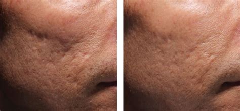 Acne Scar Treatments With Juvederm Dr Michele Green Md