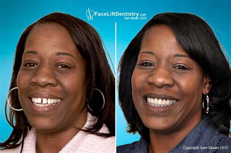 Answers to some other common questions. Fixing Buck Teeth (Protruding Teeth)