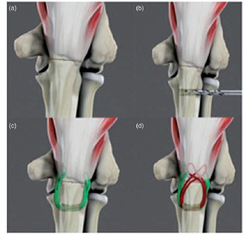 Figure 2 From Tension Band Suture Fixation For Olecranon Fractures