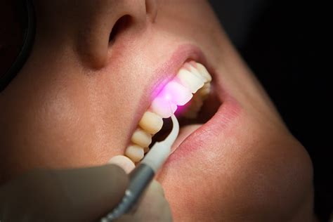 All About Laser Gum Treatment Dental Wellness Group