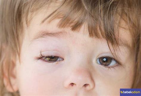Çocuklarda Göz Nezlesi Neden Olur? Ne İyi Gelir?
