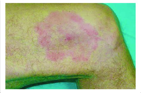 Erythema Migrans Of The Thigh Download Scientific Diagram