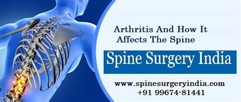 Pin On Spine Surgery India