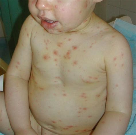 Chickenpox In Babies Symptoms Prevention And Treatment