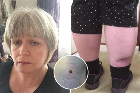 Sun Lover Left With A Crater In Her Leg After Tiny Freckle Turns Out To Be Deadly Skin Cancer