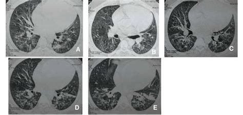 A Lung High Resolution Computed Tomography Hrct A B C D E