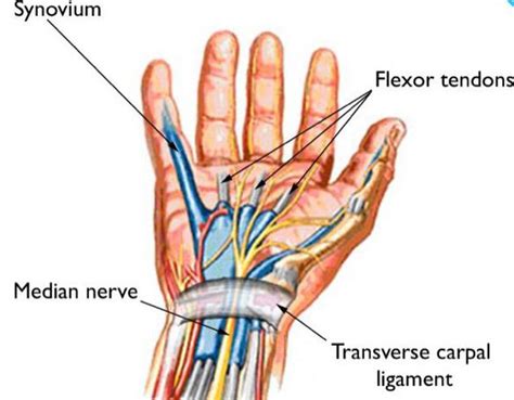 Carpal Tunnel Syndrome Medizzy