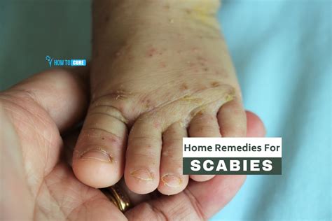 Maybe you would like to learn more about one of these? Top 5 Astonishing Natural And Home Remedies For Scabies ...