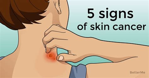 5 Signs Of Skin Cancer Other Than Mole
