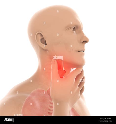 Sore Throat Illustration Stock Photo Alamy